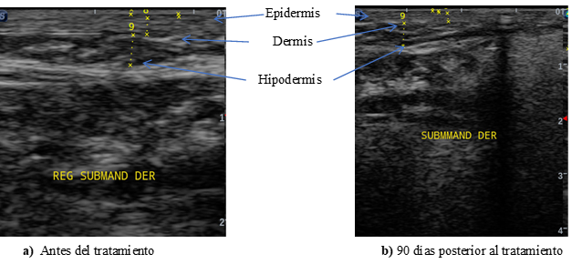 Figura 1. Evaluación ecográfica comparativa de la región submandibular derecha