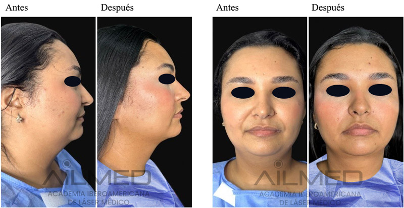 Figura 3. Evolución clínica a los 90 días del procedimiento según registro fotográfico