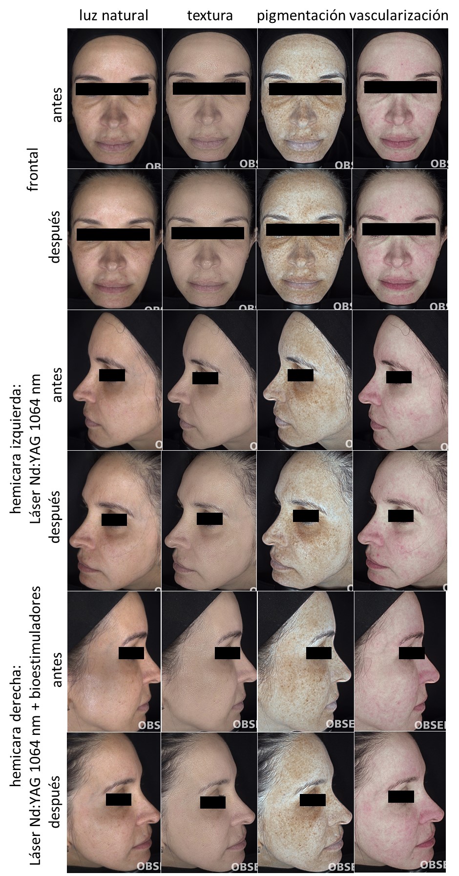 Paciente 1. Registro fotográfico de antes y después del tratamiento por hemicara