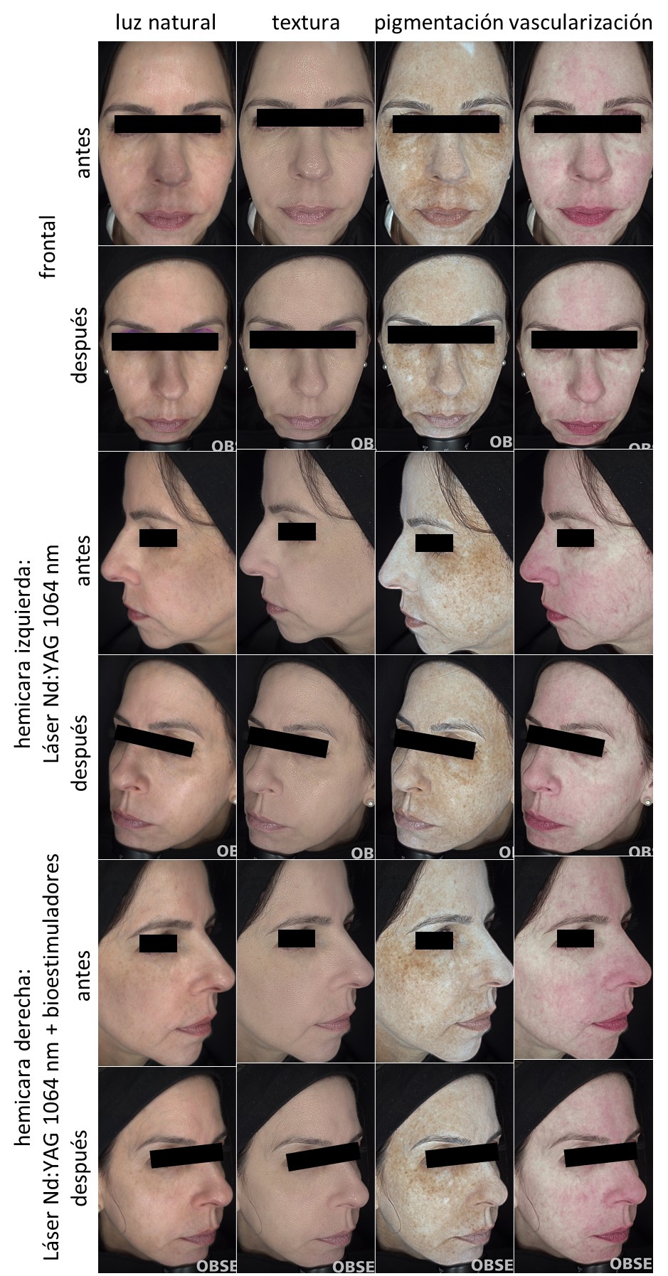 Paciente 2. Registro fotográfico de antes y después del tratamiento por hemicara