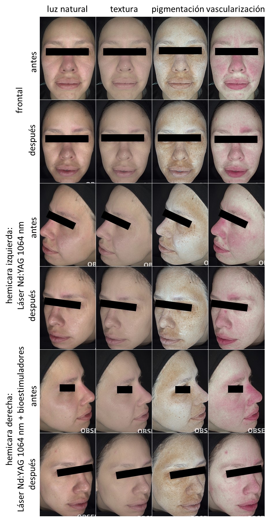 Paciente 3. Registro fotográfico de antes y después del tratamiento por hemicara