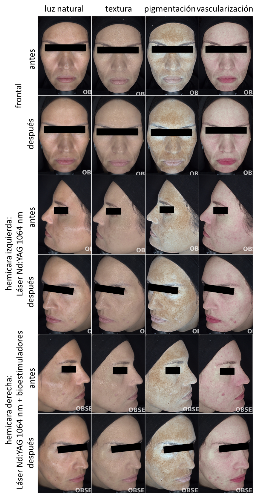 Paciente 4. Registro fotográfico de antes y después del tratamiento por hemicara