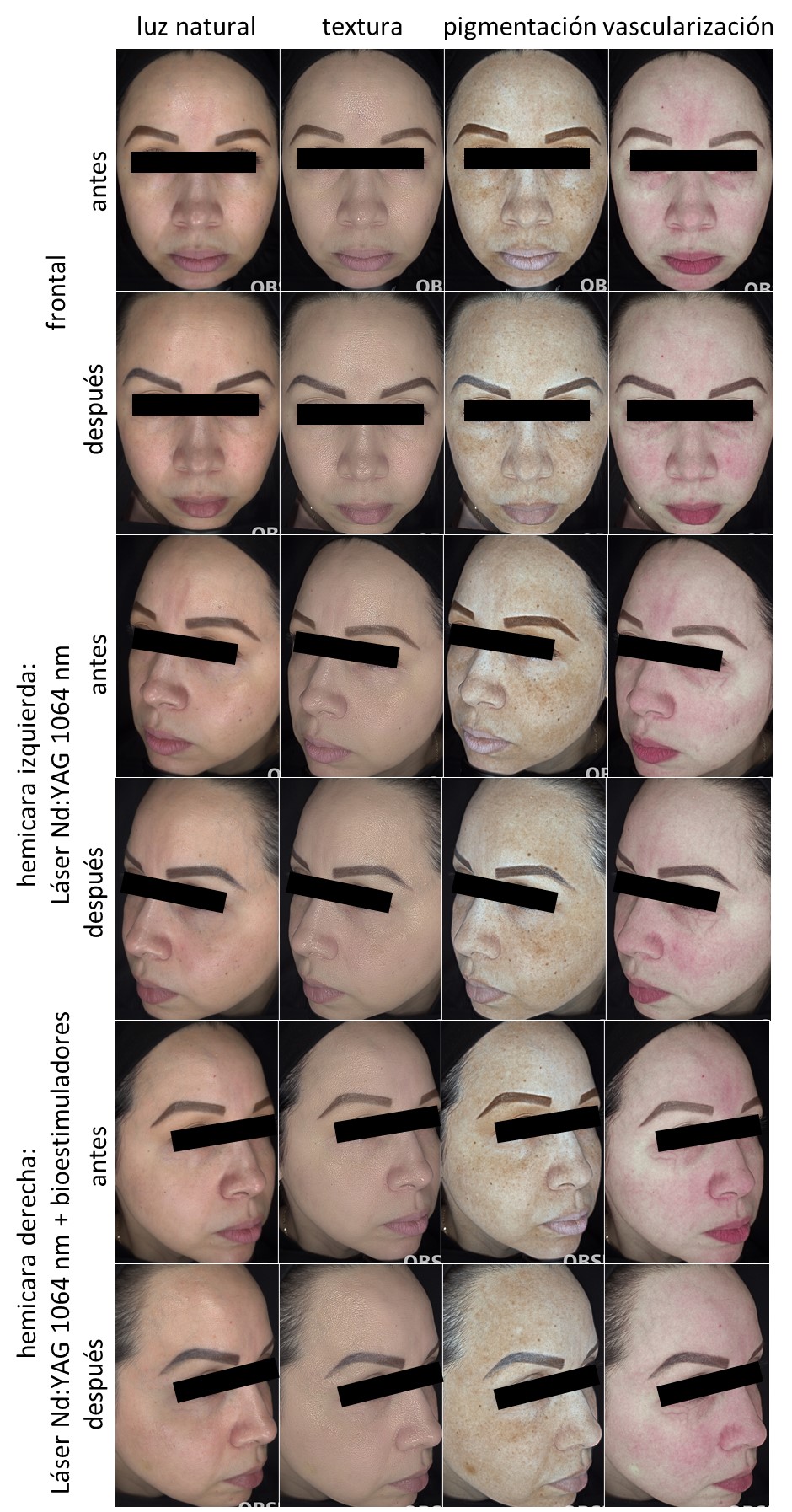 Paciente 5. Registro fotográfico de antes y después del tratamiento por hemicara