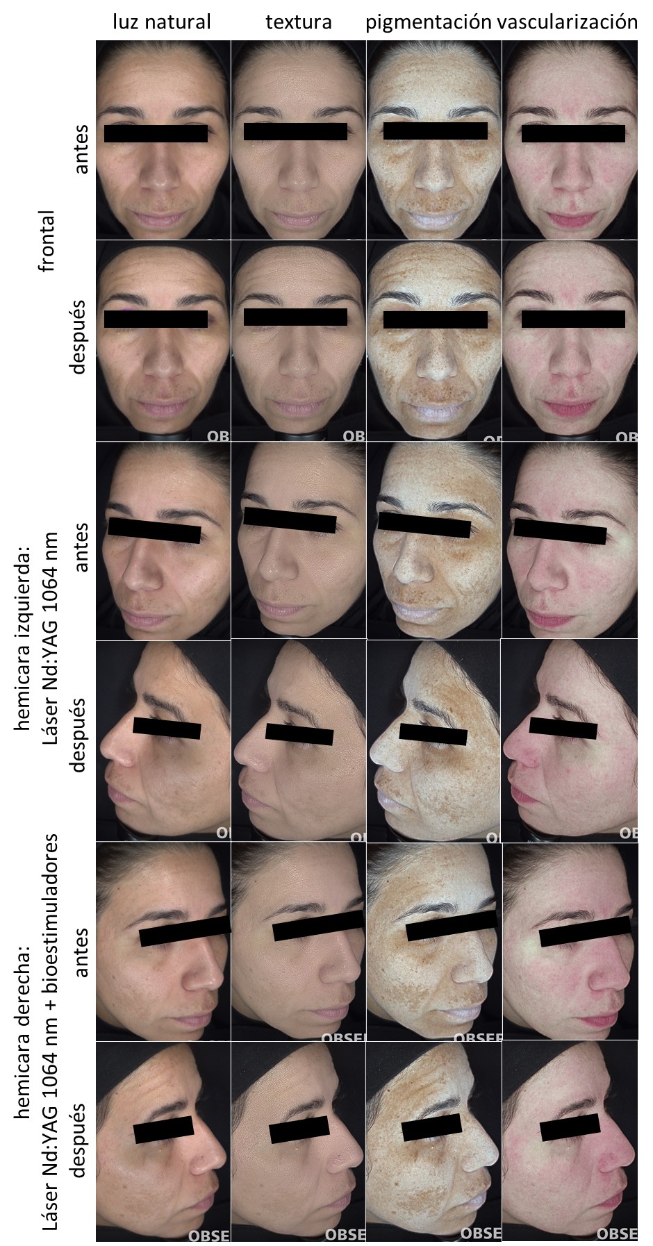 Paciente 6. Registro fotográfico de antes y después del tratamiento por hemicara