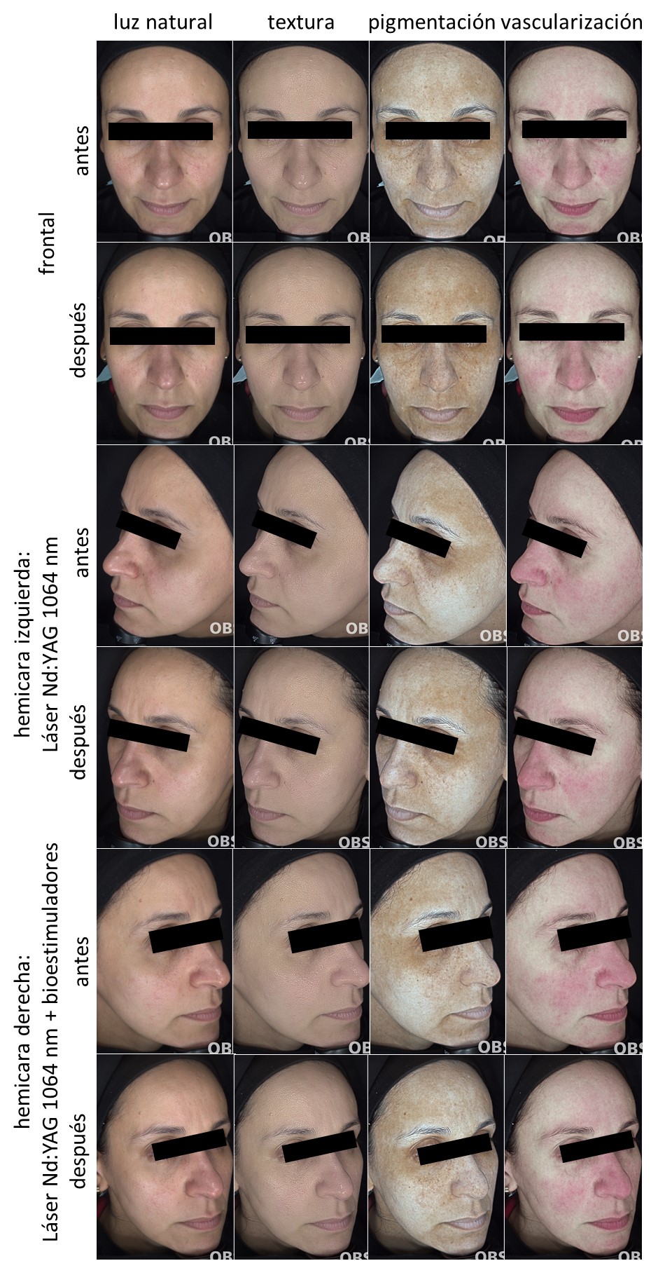 Paciente 7. Registro fotográfico de antes y después del tratamiento por hemicara