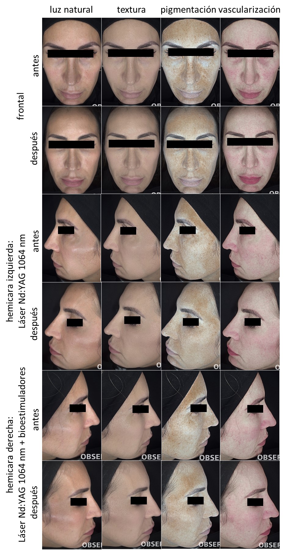 Paciente 8. Registro fotográfico de antes y después del tratamiento por hemicara