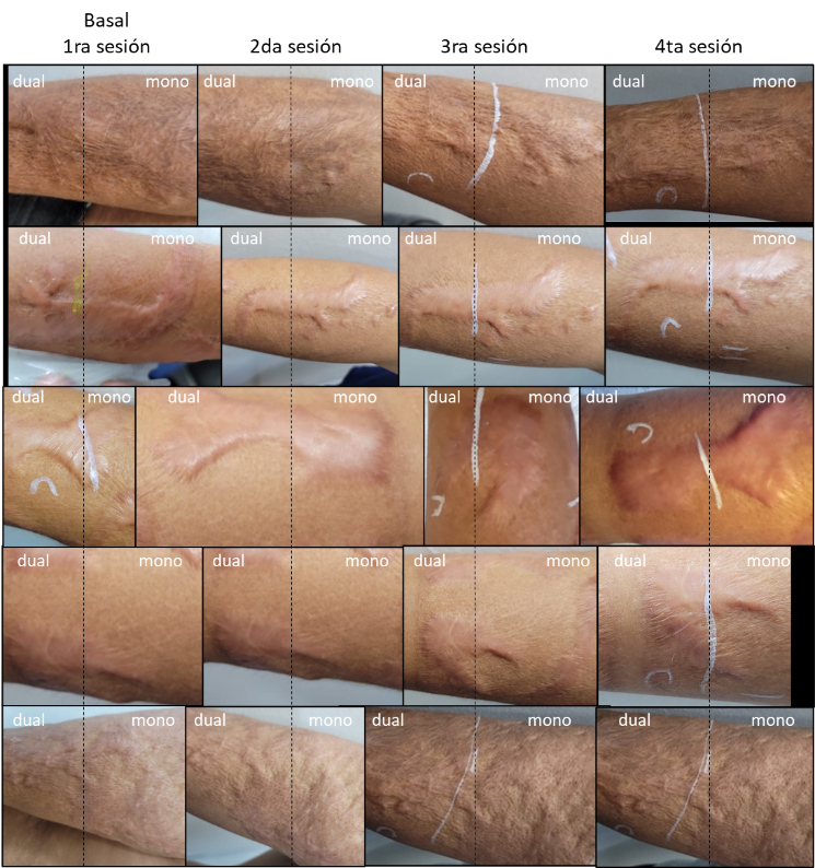 Figura 1. Seguimiento de la evolución clínica por sesión de tratamiento de las cicatrices post quemaduras ubicadas en brazos. Lado izquierdo: terapia dual (láser CO<sub>2</sub> mas exosomas) y lado derecho: monoterapia (láser CO<sub>2</sub>)
