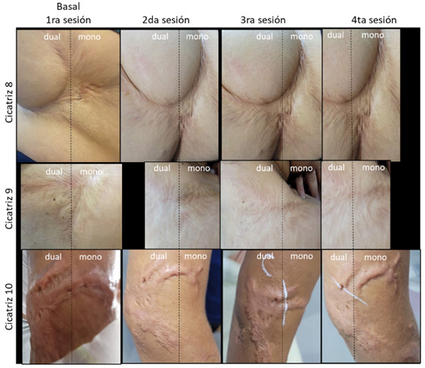 Figura 3. Evolución clínica de las cicatrices post quemaduras tratadas con láser CO<sub>2</sub> más exosomas (terapia dual) y únicamente láser CO<sub>2</sub> (monoterapia), según la Escala de Cicatrización de Vancouver (VSS).