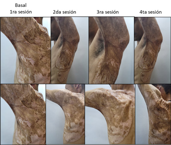 Figura 7. Disminución de la atrofia funcional del hombro con intervención láser CO<sub>2</sub> más exosomas combinando secuencias en axila y región dorsal posterior izquierda.