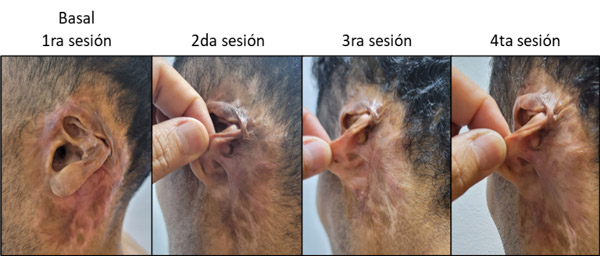 Figura 8. Aumento en el despliegue de la región retroauricular izquierda.