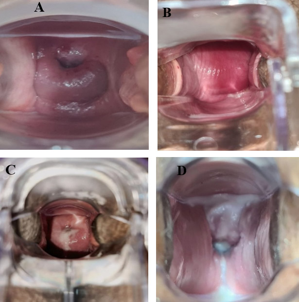 Gráfico 6. Evaluación del grado de dolor en pacientes con síndrome genitourinario de la menopáusica tratadas con láser fraccionado de CO2. Puyo – Ecuador. Septiembre 2024 a marzo 2025