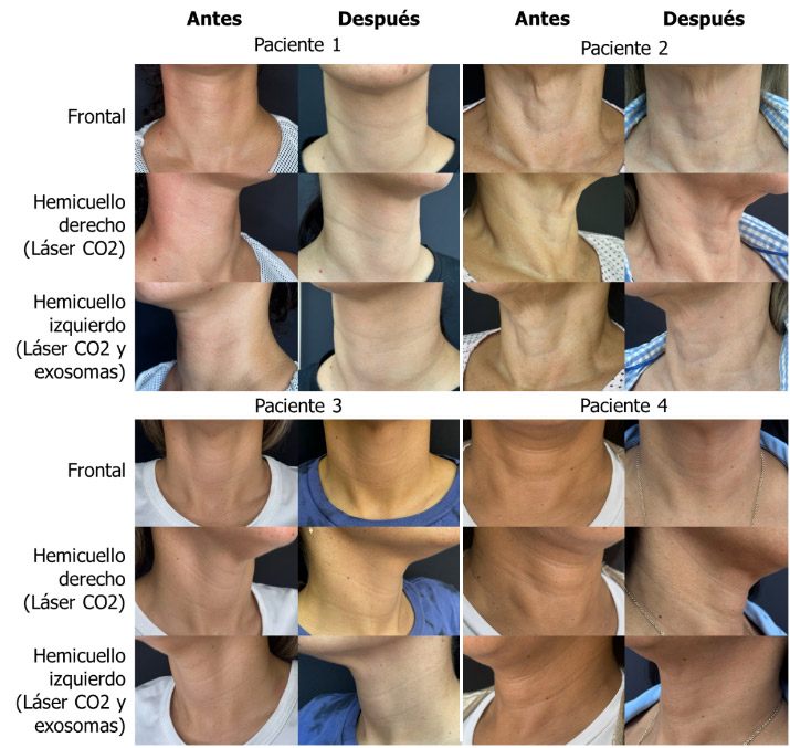 Figura 1. Resultados en el rejuvenecimiento del cuello con láser CO2 fraccionado en el hemicuello derecho y láser CO2 fraccionado combinado con exosomas en hemicuello izquierdo de 4 pacientes incorporadas al estudio.