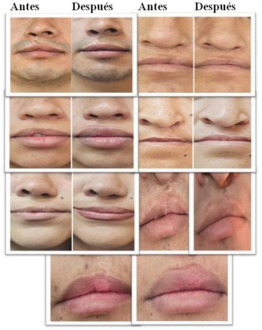 Figura 1. Fotos representativas de siete pacientes del género femenino y masculino y su evolución clínica de las cicatrices post queiloplastia, antes, y después de 4 sesiones de tratamiento. Registro frontal del rostro: tratamiento de terapia combinada de láser Erbio YAG 2940 con enzimas recombinantes.