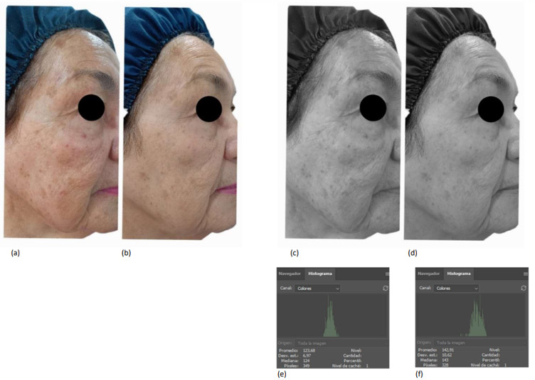 Figura 3. Registro fotográfico de los resultados obtenidos antes y después del tratamiento IPL en lentigos solares
