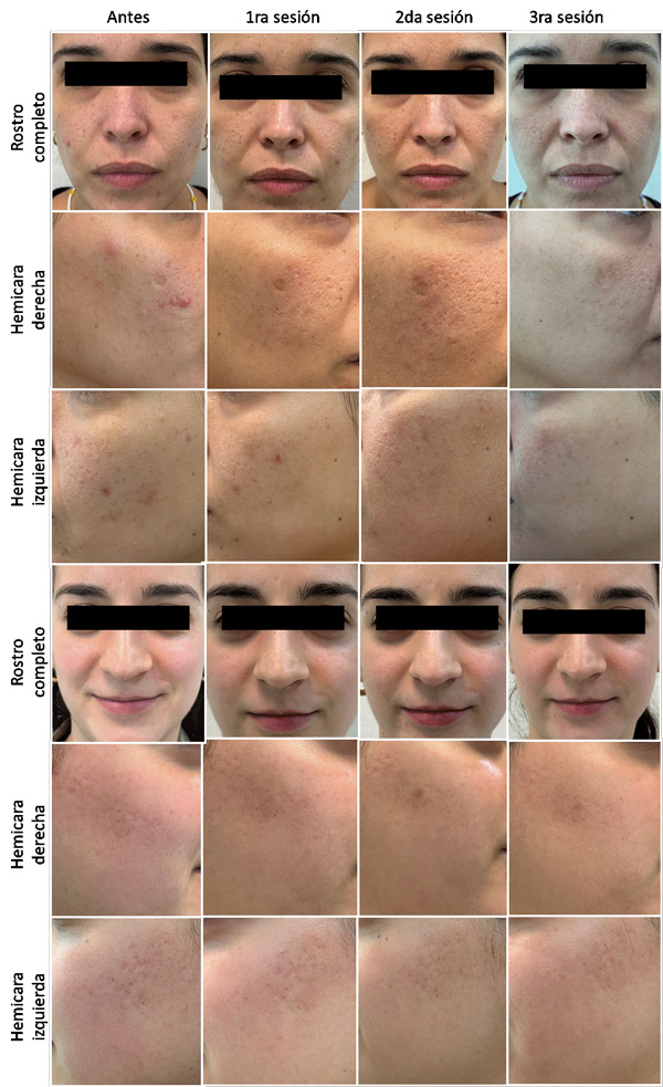 Figura 2. Fotos representativas de dos pacientes del género femenino y su evolución clínica de la severidad de cicatrices post acné, antes, durante y después de tres sesiones de tratamiento. Registro frontal del rostro completo; Hemicara derecha: tratamiento láser Er:YAG con Nd:YAG de pulso largo; Hemicara izquierda: tratamiento láser Er:YAG con Nd:YAG micropulsado